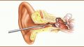 Causes and Symptoms of Ear Wax
