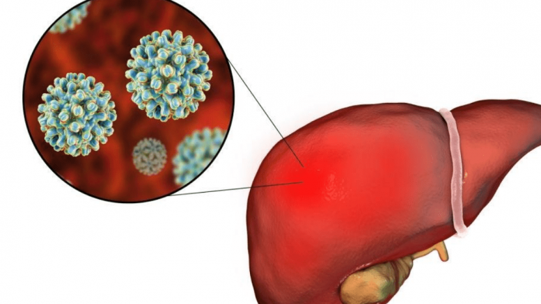 Hepatitis B Symptoms And Signs